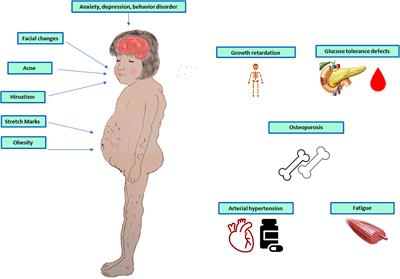 Adrenal Cushing’s syndrome in children